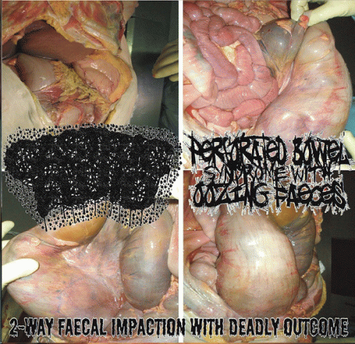 Gastric Fluid : 2-Way Faecal Impaction with Deadly Outcome